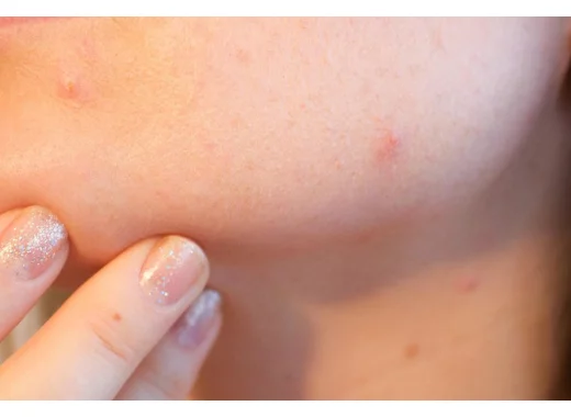 L'obsession d'un défaut de l'apparence corporelle