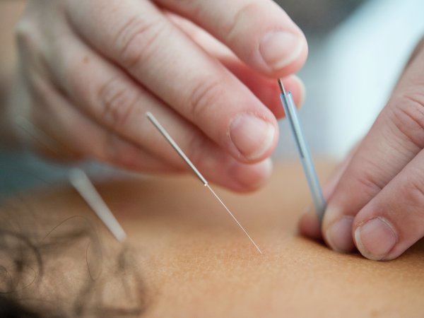 L'acupuncture est-elle efficace ?