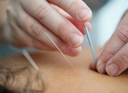 L'acupuncture est-elle efficace ?
