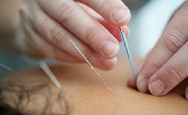 L'acupuncture est-elle efficace ?