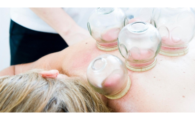 Ventouses, hijama, cupping : une pratique thérapeutique à la mode sans preuve scientifique